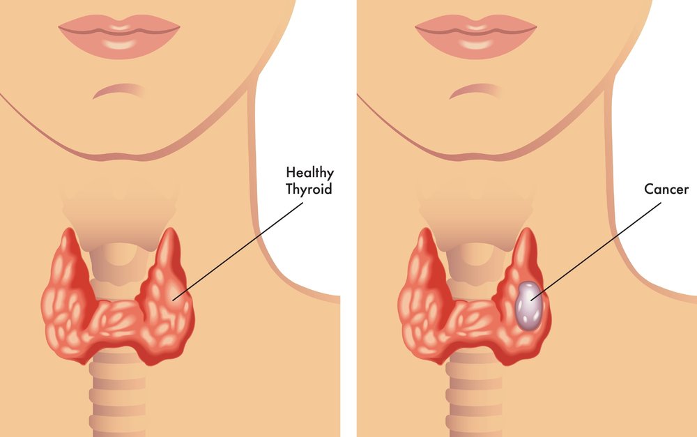 An illustration of what Thyroid Cancer looks like.