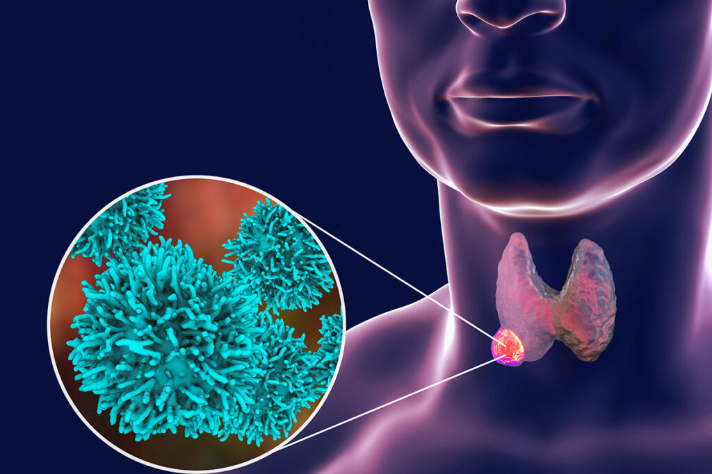 A digital rendering of Thyroid Cancer.