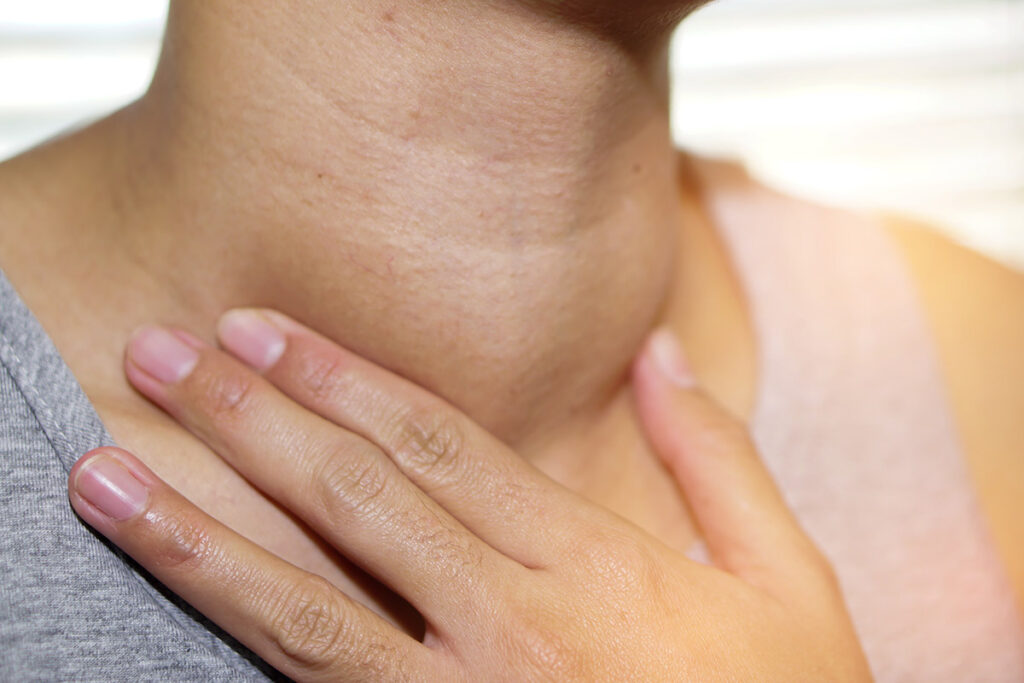 A woman with an abnormal enlargement of her thyroid gland.